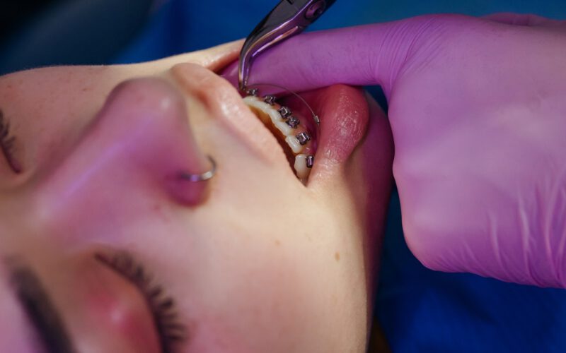 Kiedy warto zdecydować się na założenie aparatu ortodontycznego?